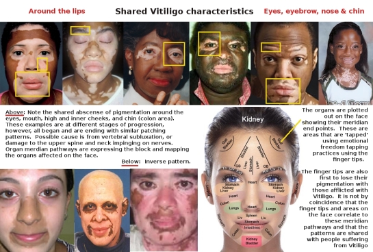 Collage of similar patterns of vitiligo
