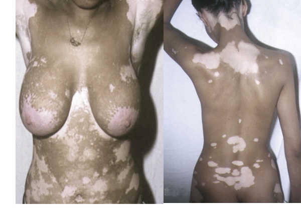 Cure for Vitiligo - The Michael Jackson skin syndrome.